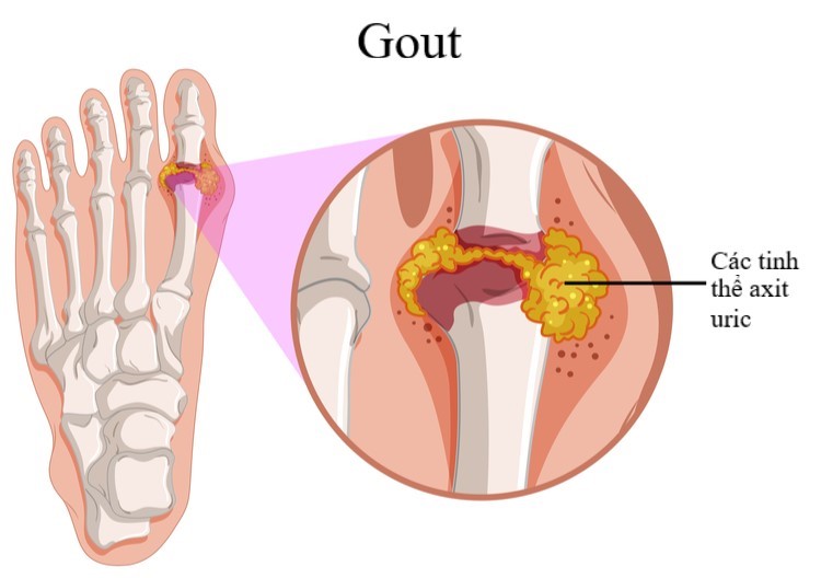 Bvweb-gout