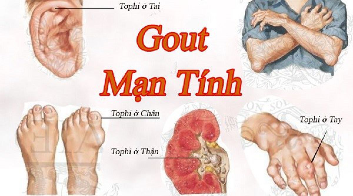 Bệnh Gout (Gút)